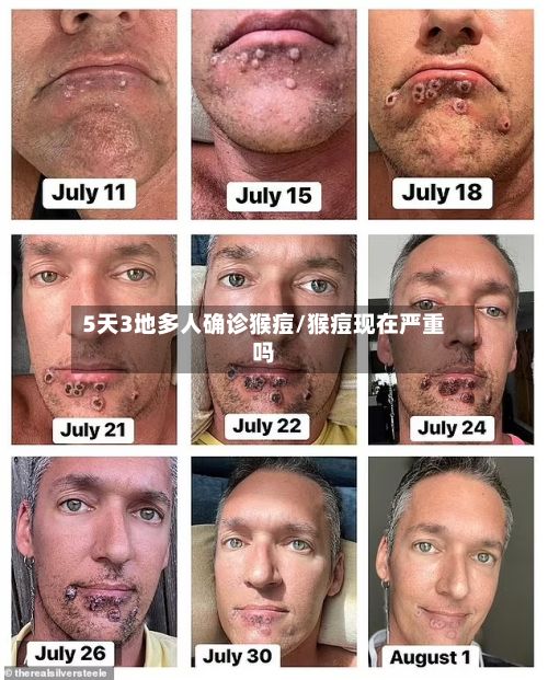 5天3地多人确诊猴痘/猴痘现在严重吗